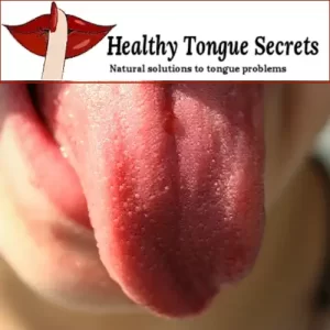 Treating and Beating Geographic Tongue and Other Tongue Problems