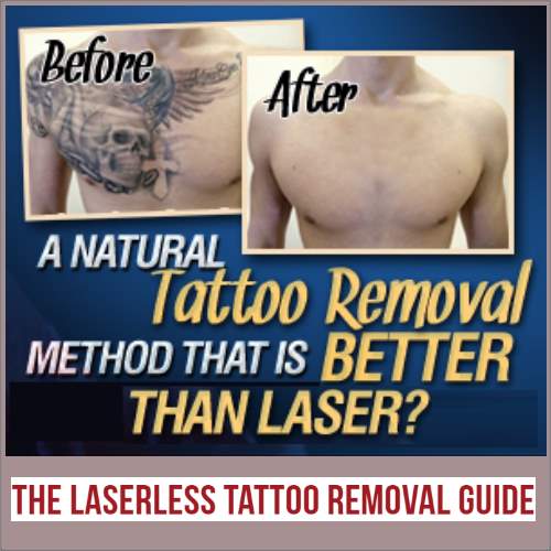 Laserless Tattoo Removal Guide