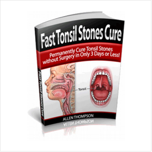 How to Cure Tonsil Stones